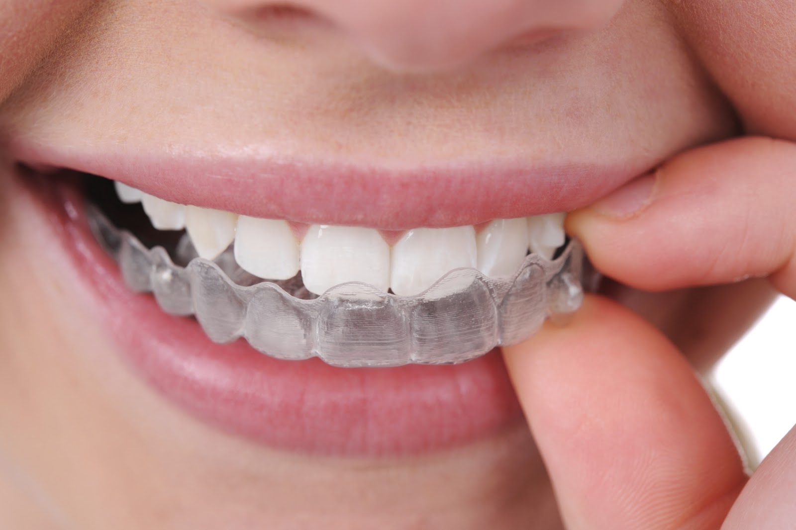 Staying Safe and Healthy with Clear Aligners during Covid 19