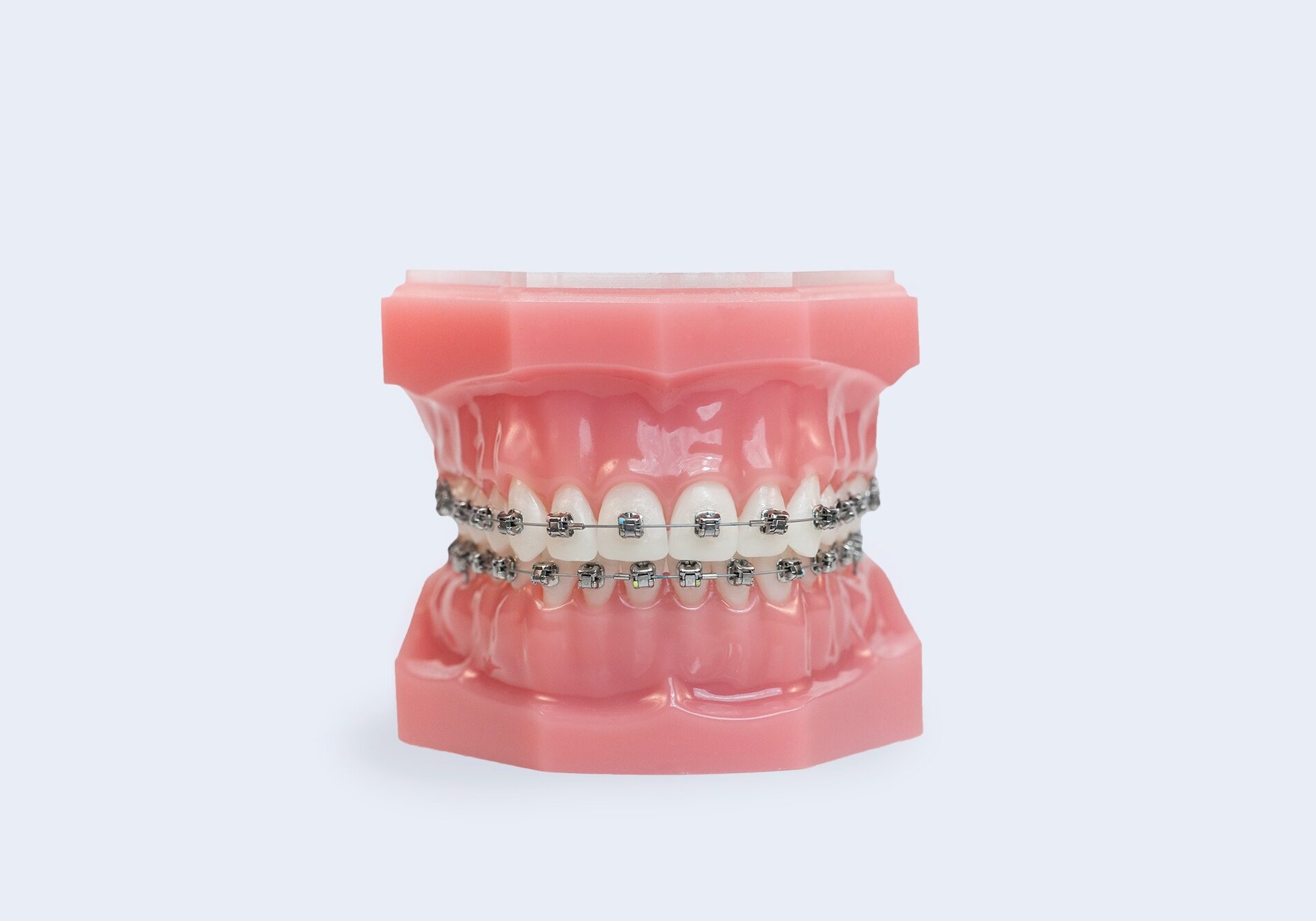 Metal Braces