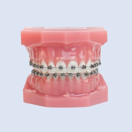 Metal braces lake mary